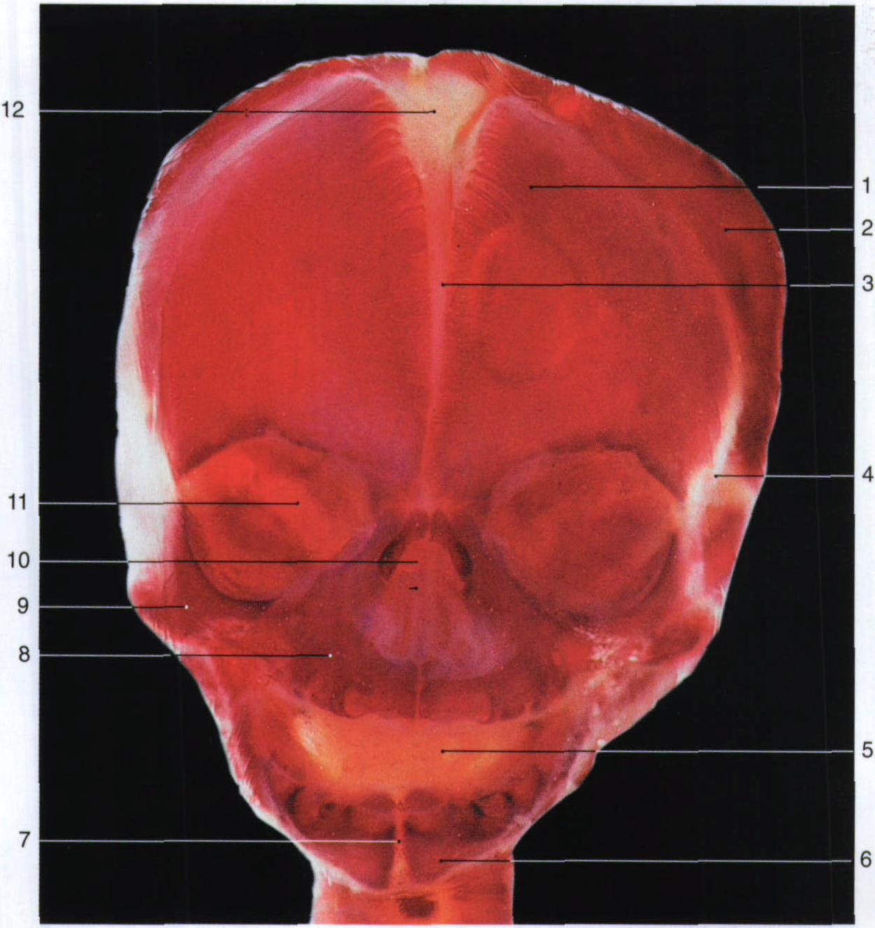 7. 胎儿透明颅骨(前面观)